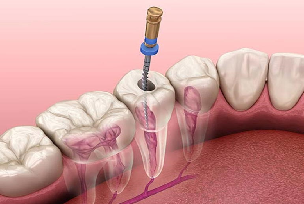 Endodontic Treatment